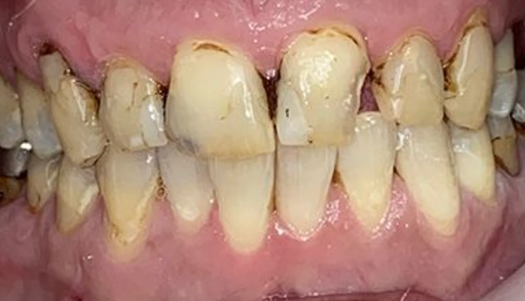 Full Mouth Restoration — before